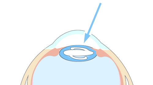 眼内レンズを挿入レンズ位置を固定