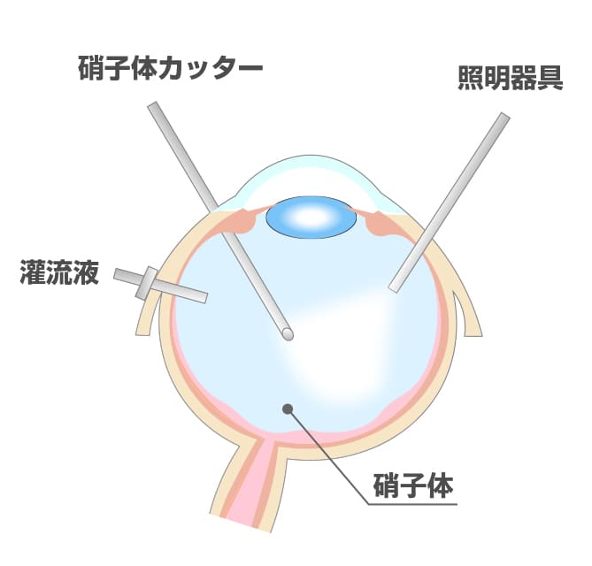 硝子体手術イメージ
