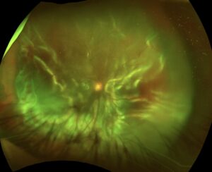 増殖性硝子体網膜症