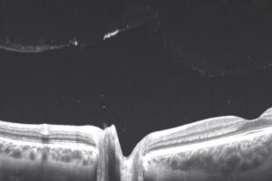 後部硝子体剥離