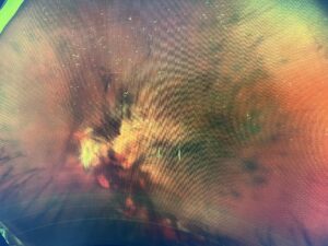 糖尿病性網膜症